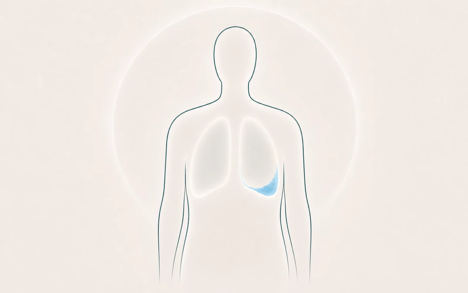 Figura anatômica com líquido pleural destacado ao redor do pulmão